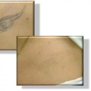 Удаление татуировок и татуажа лазером,  без шрамов