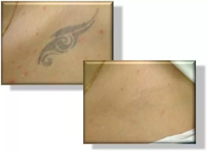 Удаление татуировок и татуажа лазером,  без шрамов