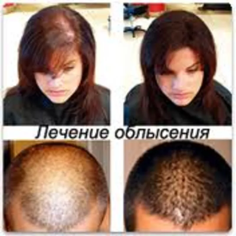 Выпадение волос.  Лечение  в Мариуполе 2